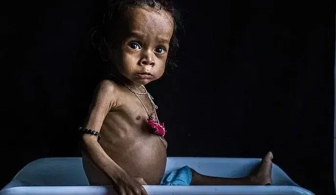 “Together We Can End Malnutrition – Aid Global Foundation